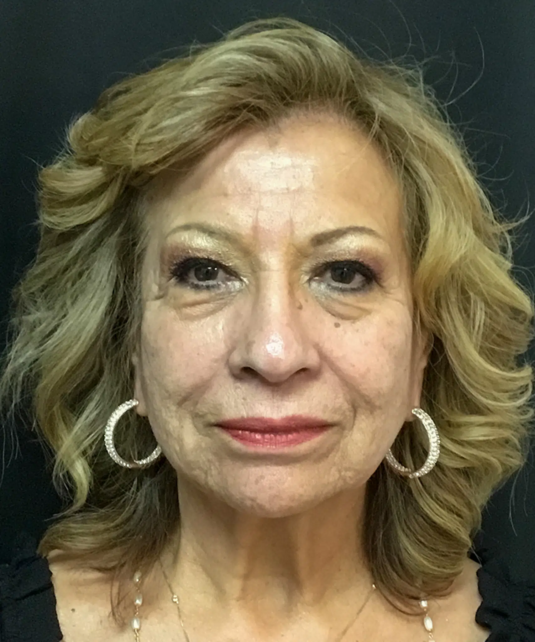 Before Bellafill treatment