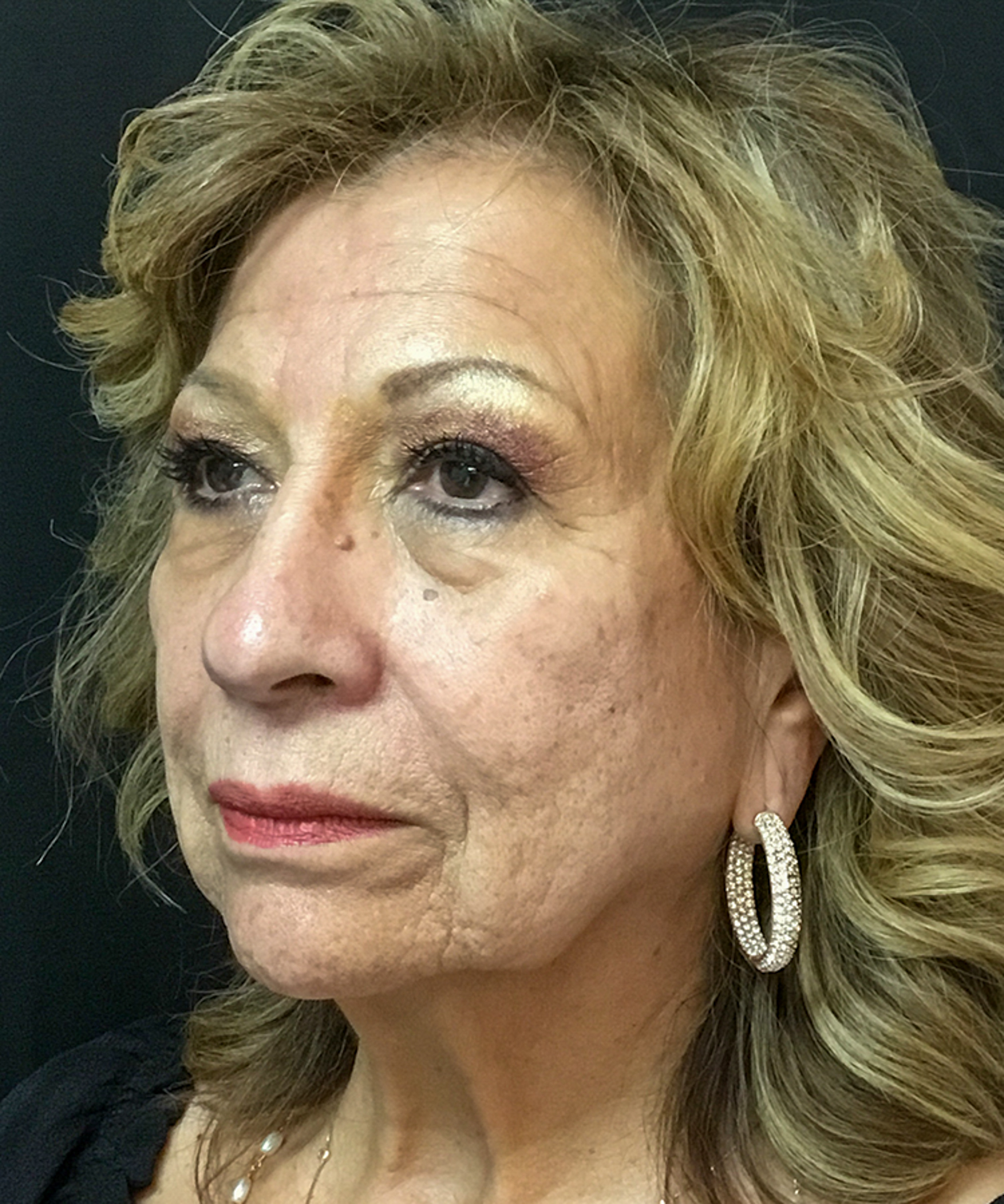 Before Bellafill treatment