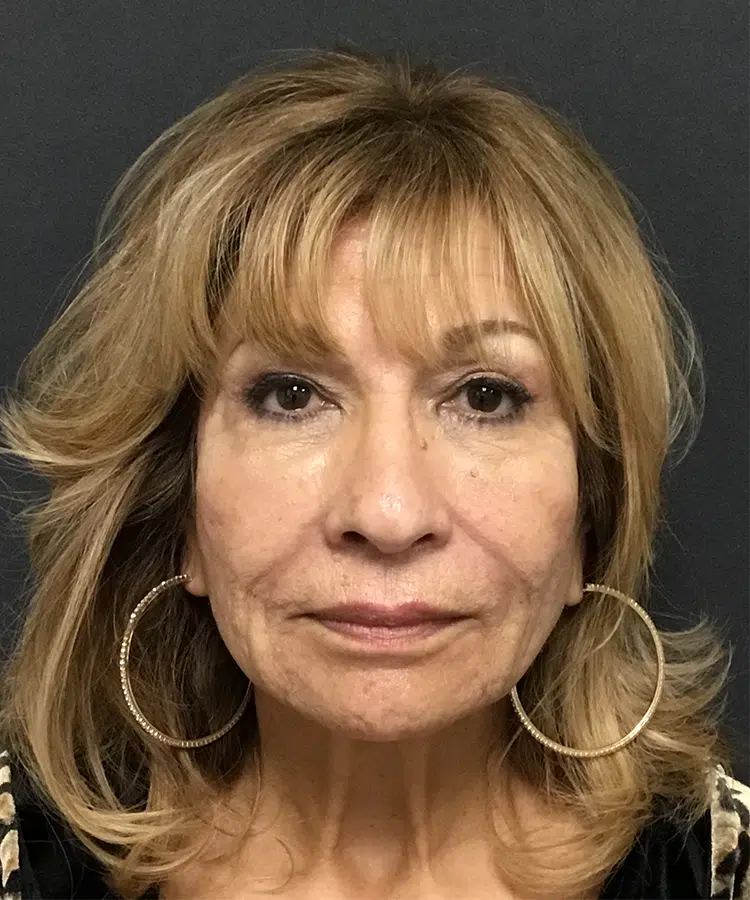 After Bellafill treatment