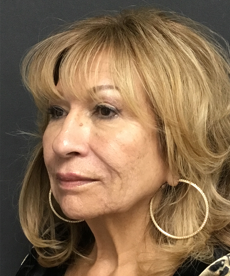 After Bellafill treatment