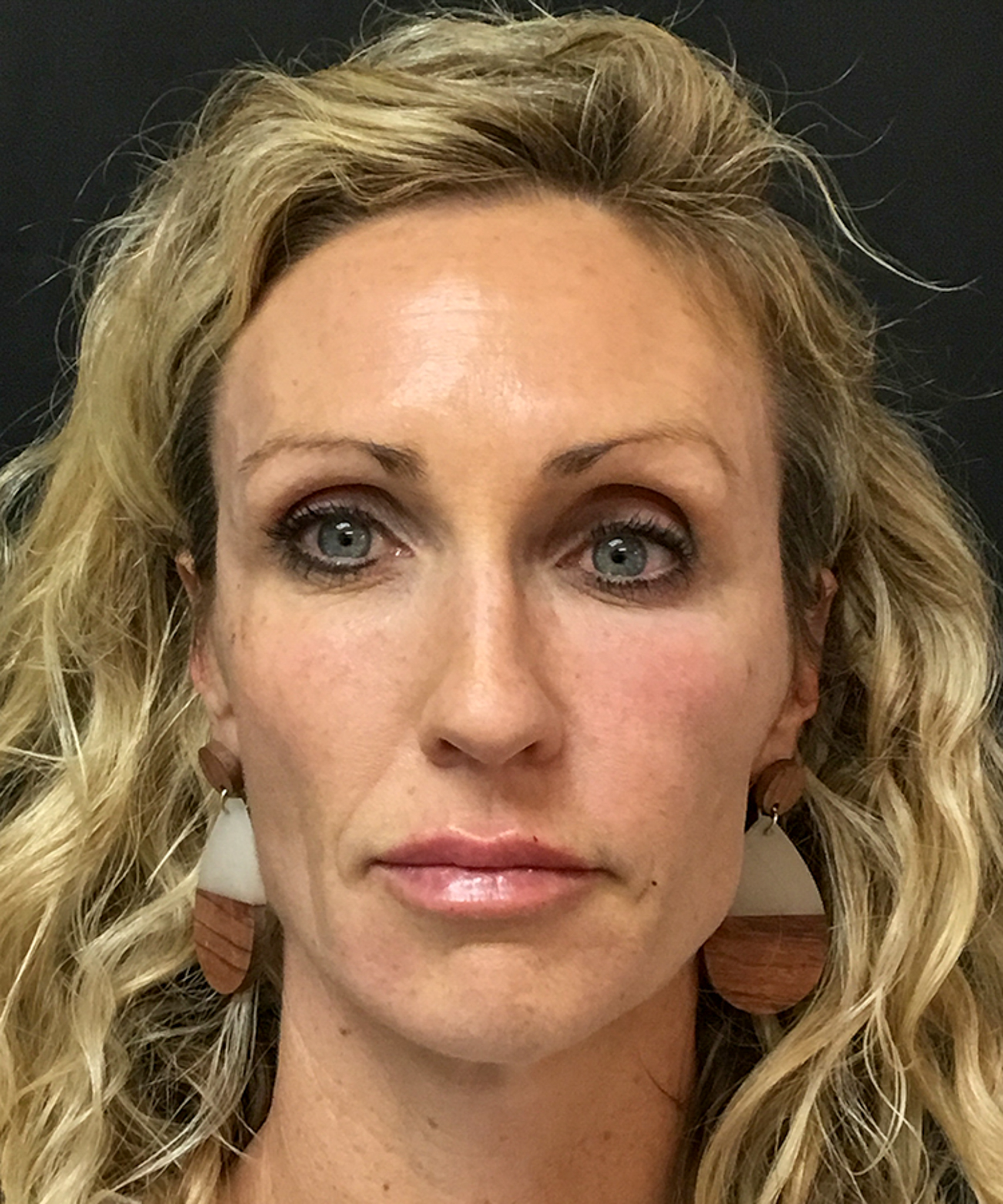 After Bellafill treatment