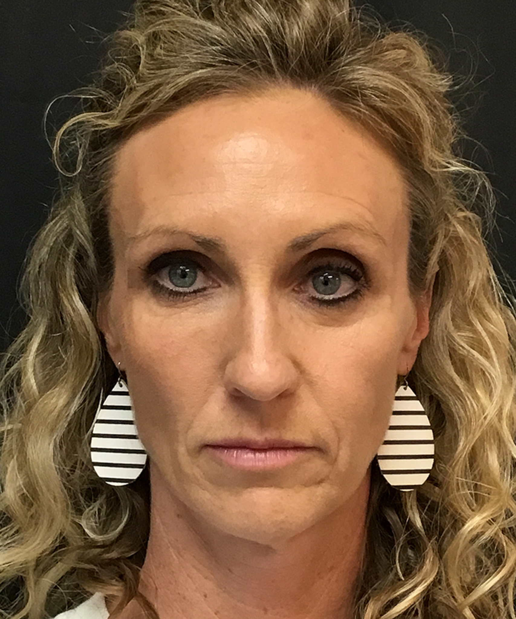 Before Bellafill treatment