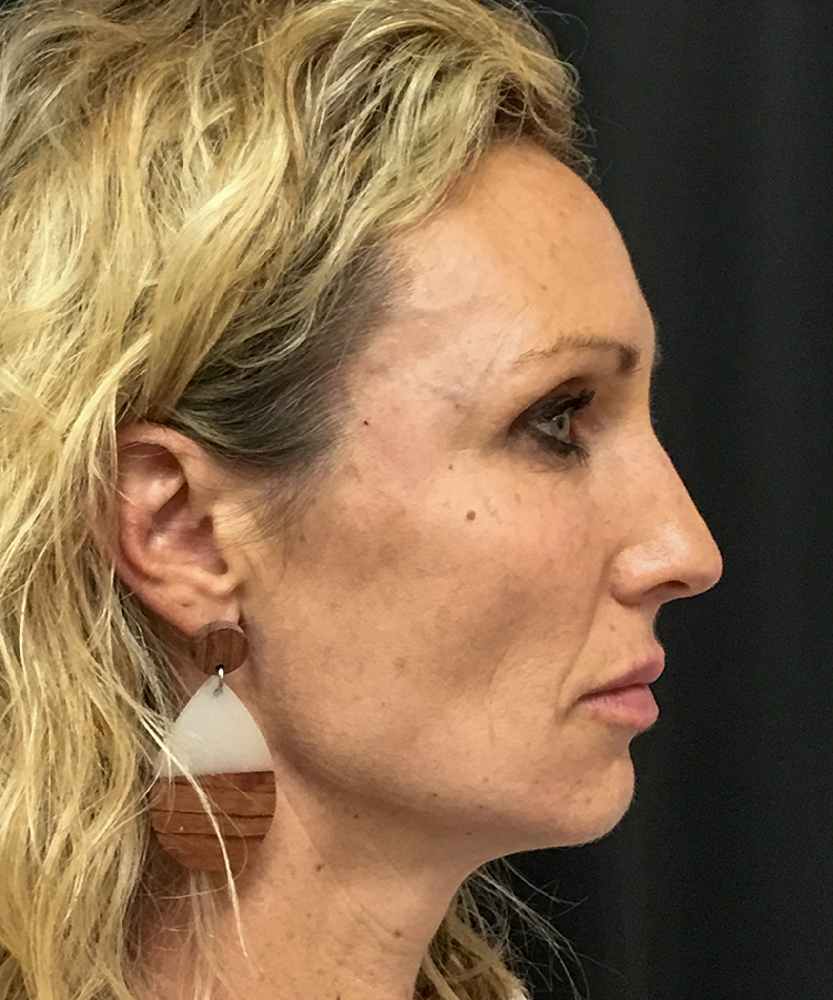 After Bellafill treatment