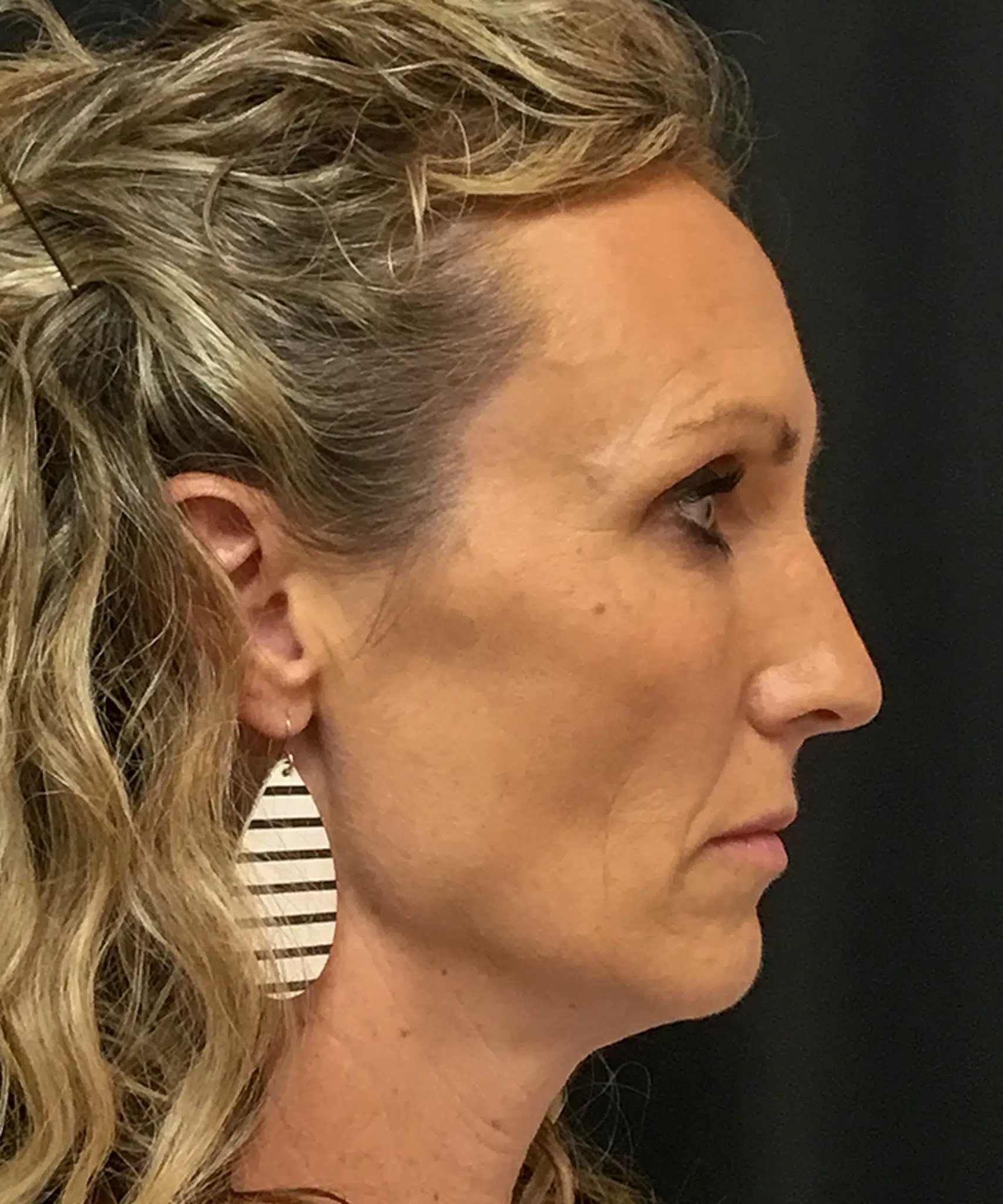 Before Bellafill treatment