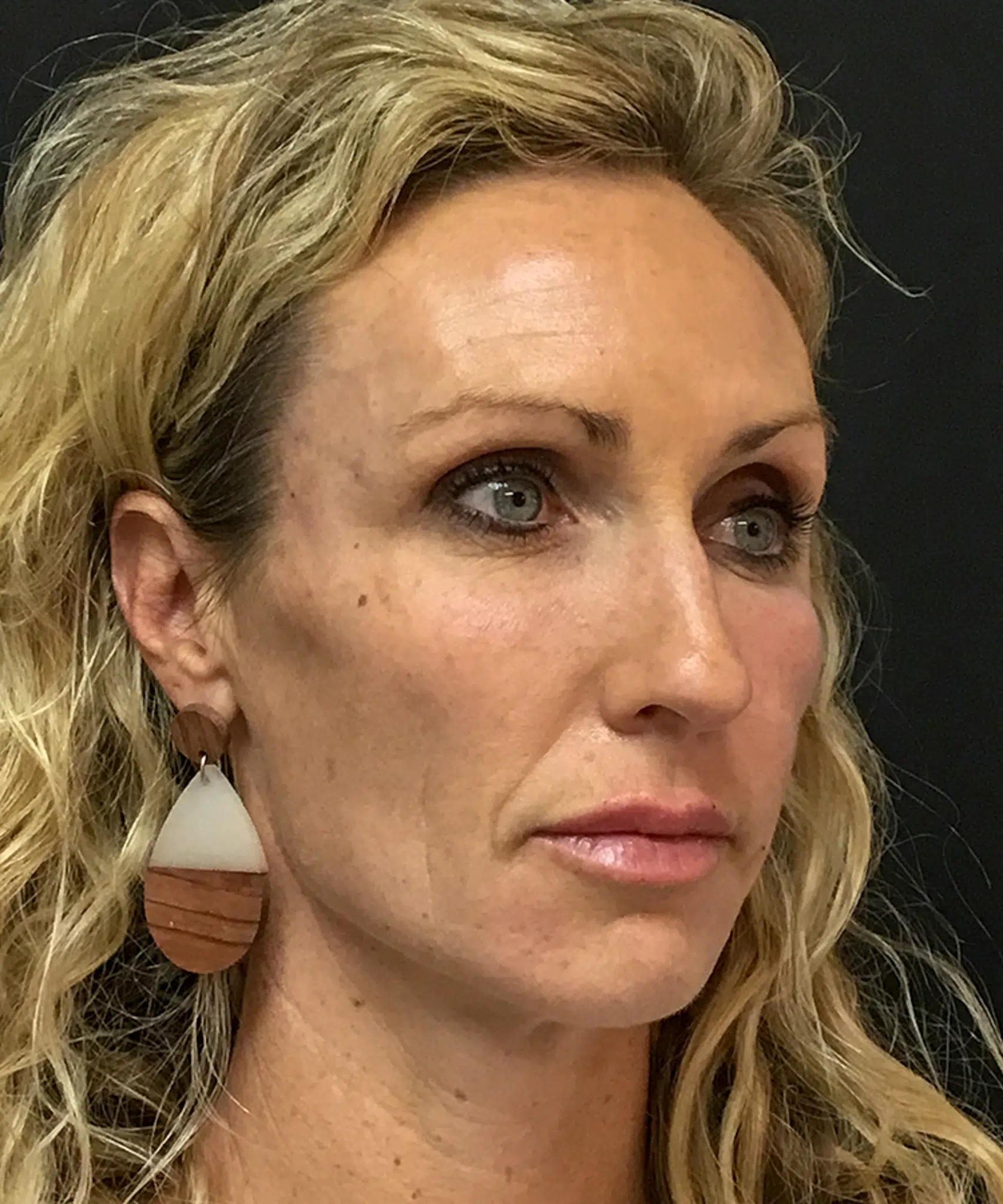 After Bellafill treatment