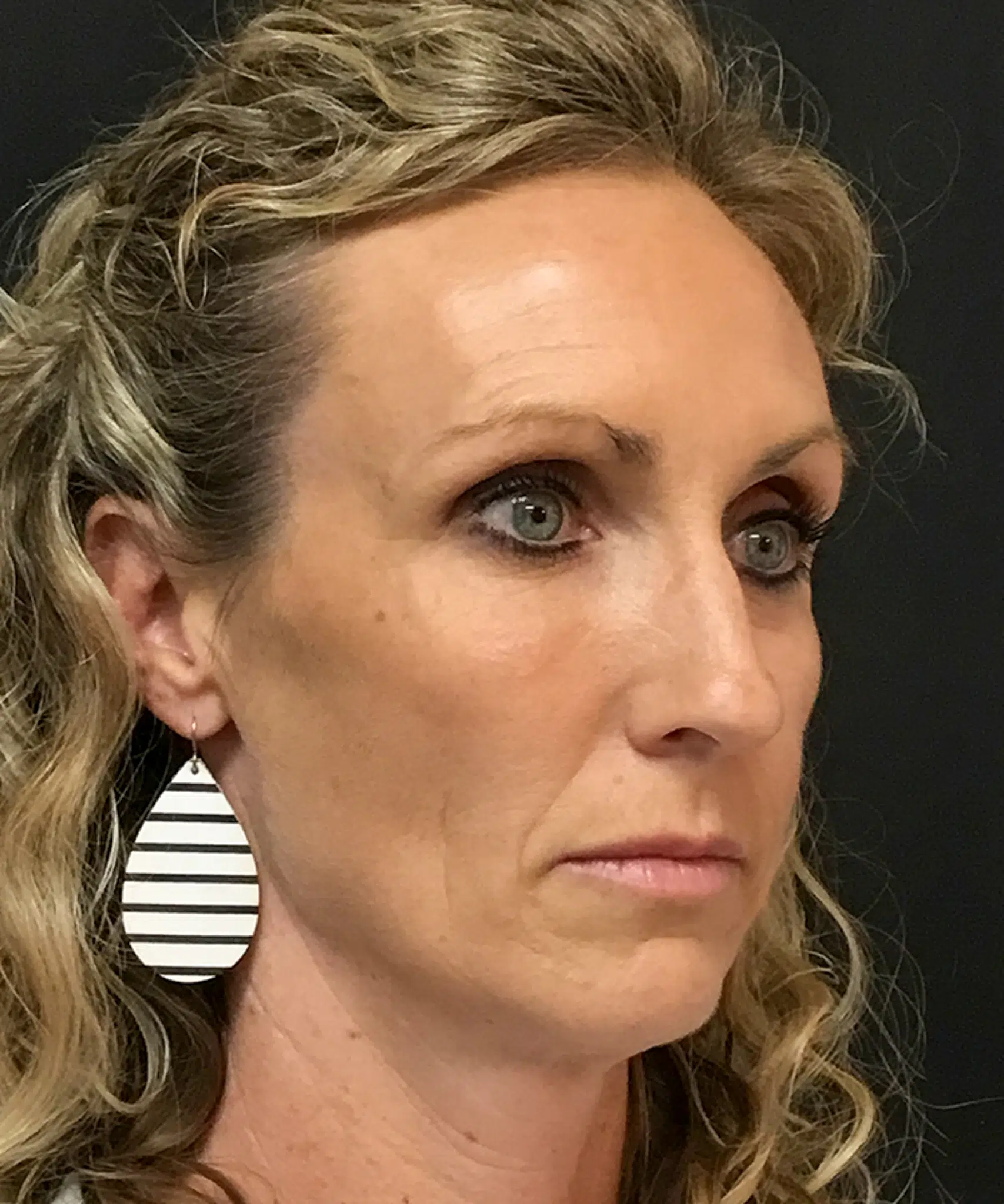 Before Bellafill treatment