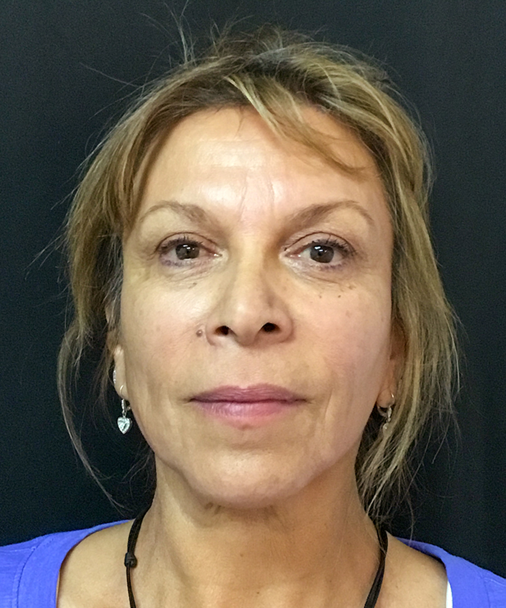 After Bellafill treatment