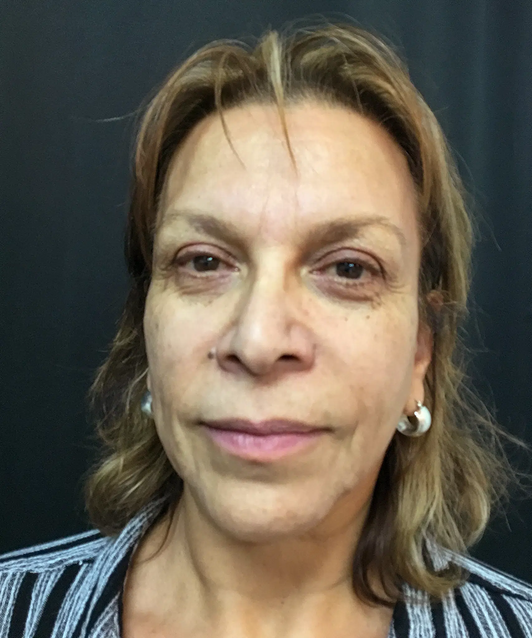 Before Bellafill treatment