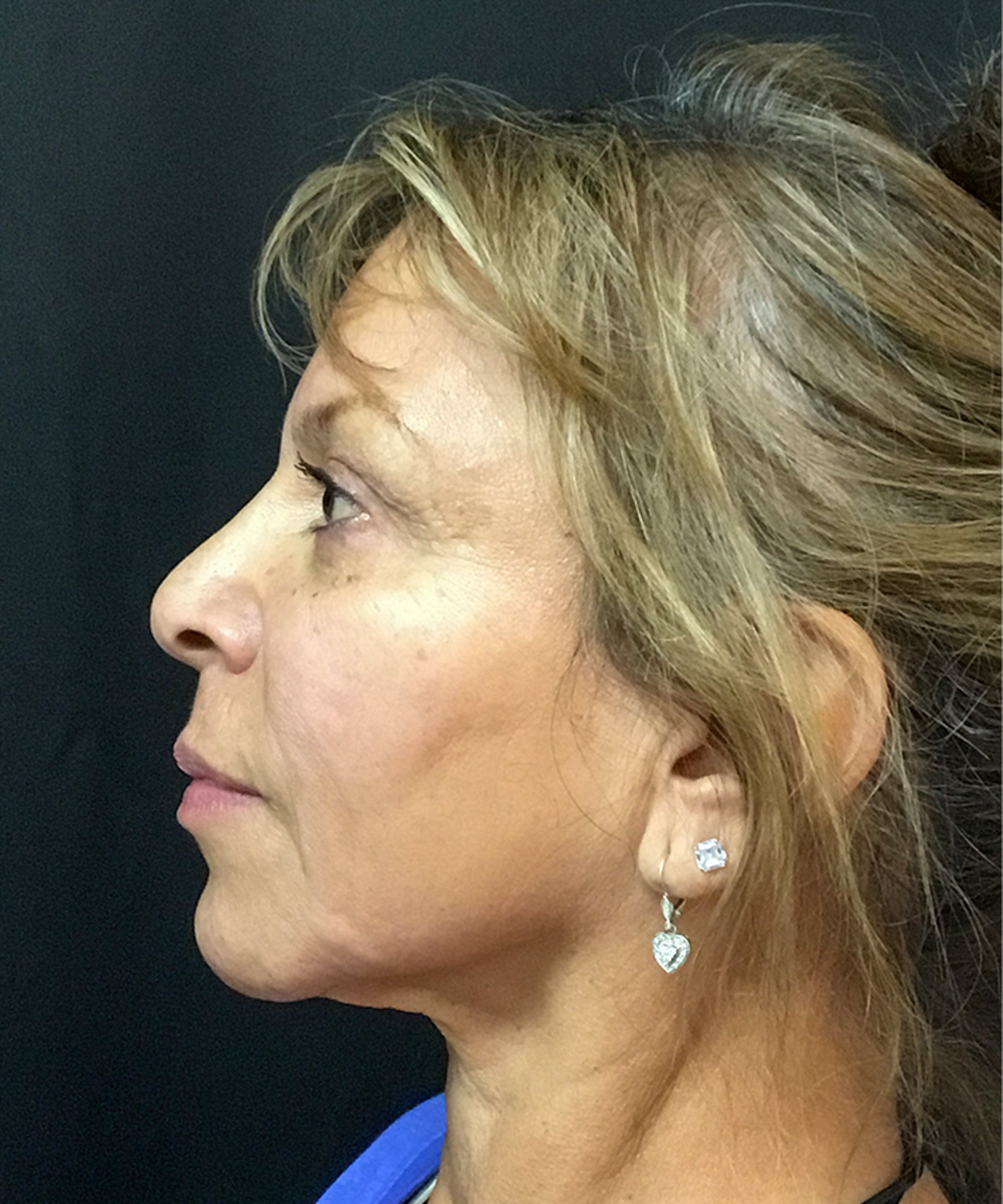 After Bellafill treatment