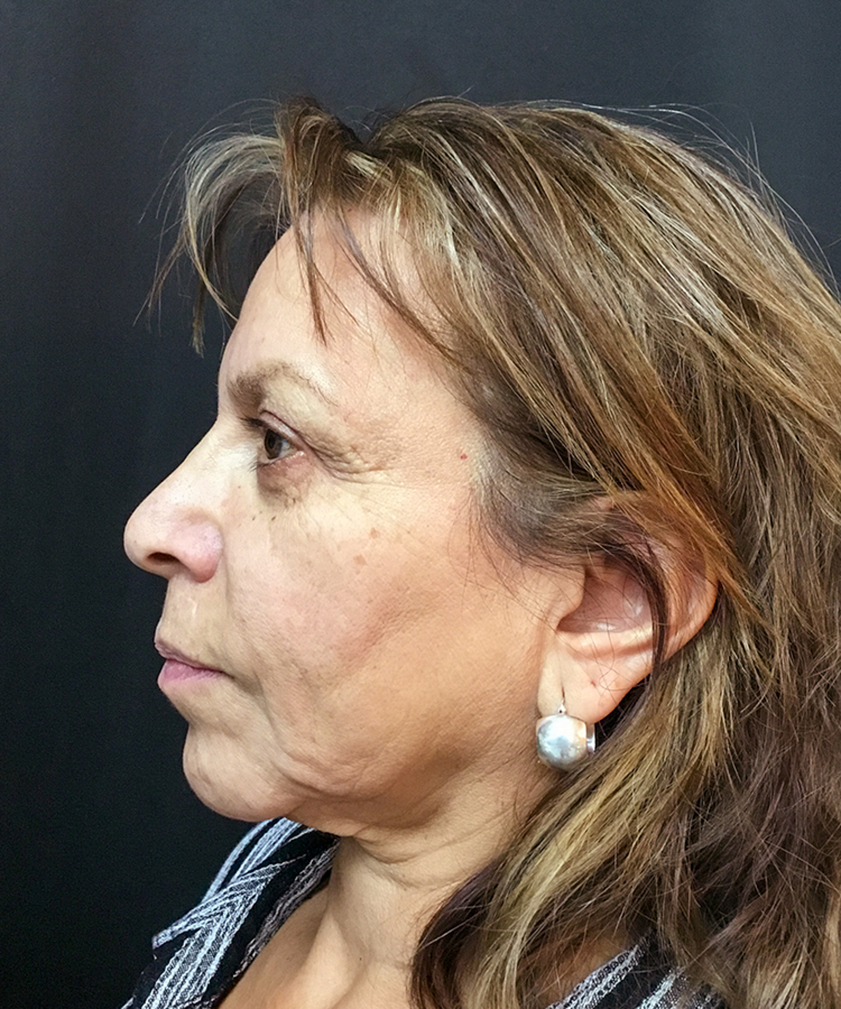 Before Bellafill treatment