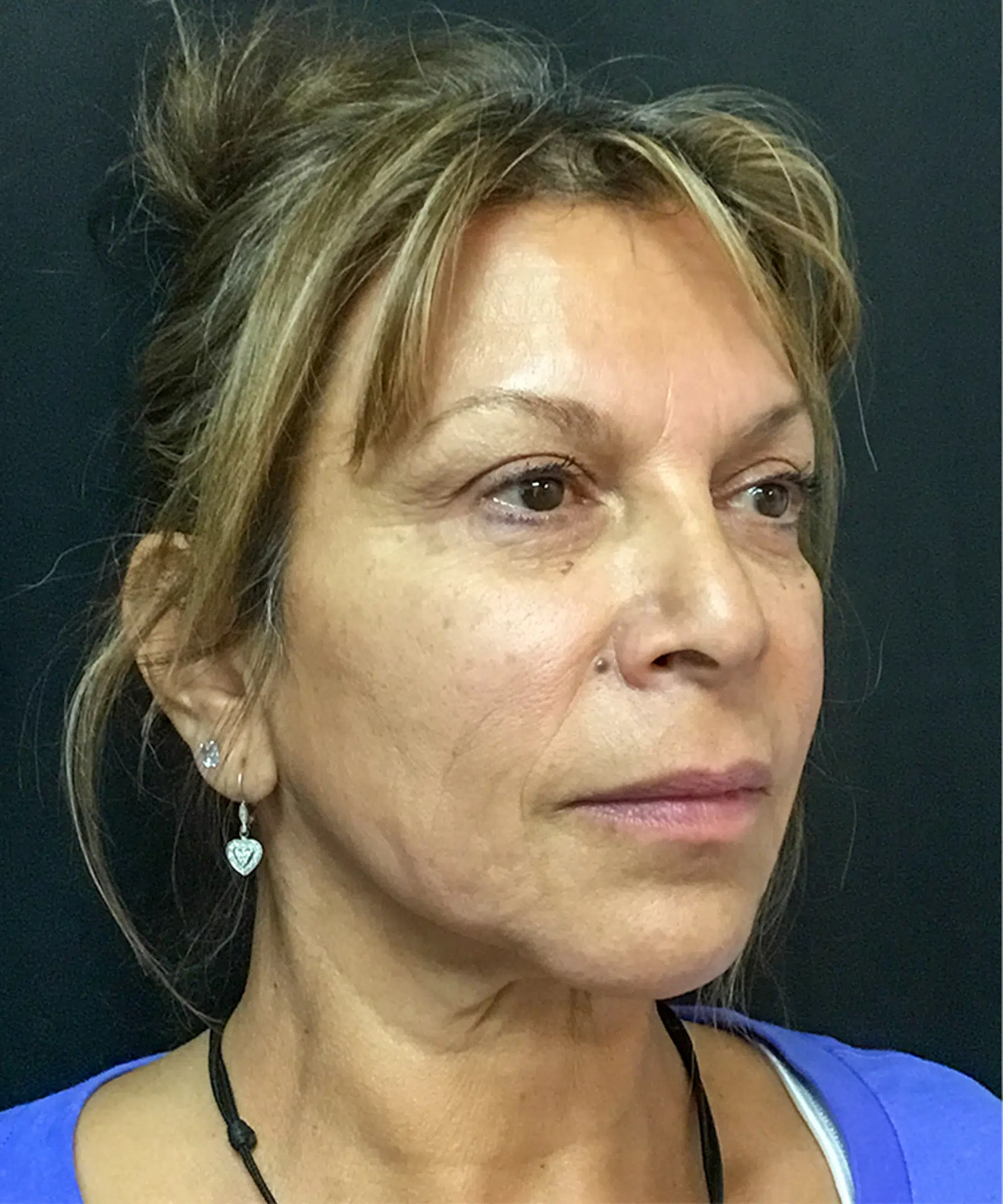After Bellafill treatment