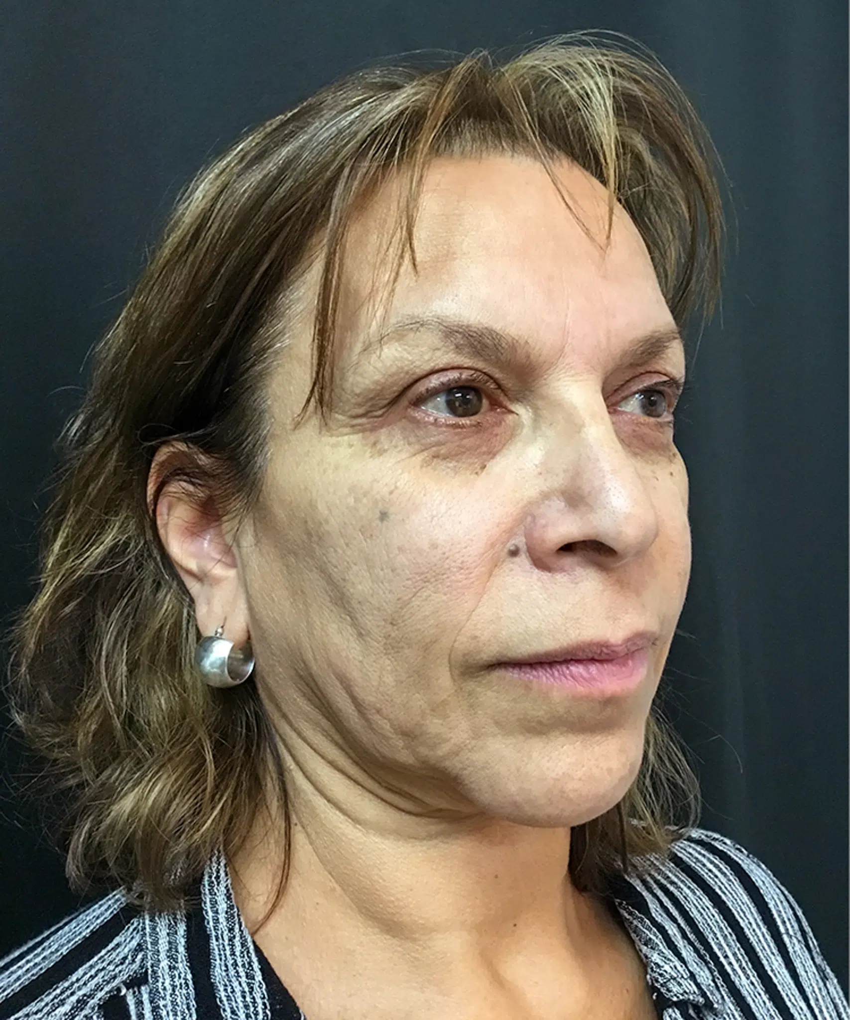 Before Bellafill treatment