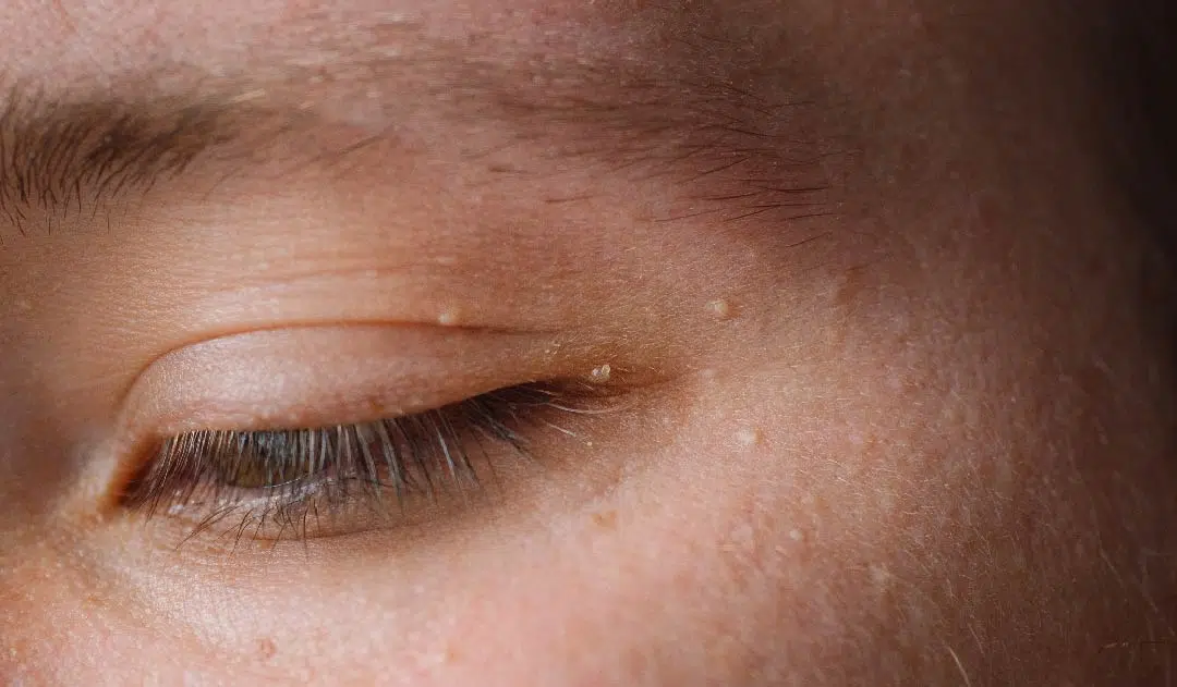 Skin Tags: What Are They and How Are They Treated?