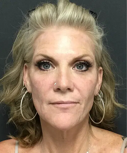 Bellafill injectable treatment for long-lasting wrinkle reduction and acne scar improvement.