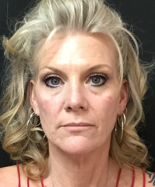 Bellafill injectable treatment for long-lasting wrinkle reduction and acne scar improvement.