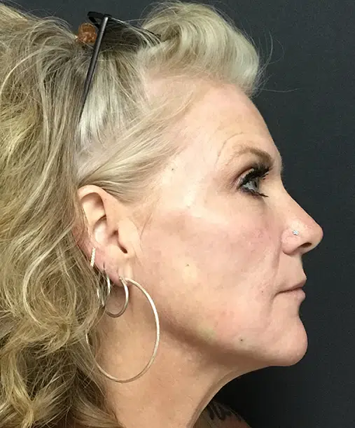 Bellafill injectable treatment for long-lasting wrinkle reduction and acne scar improvement.