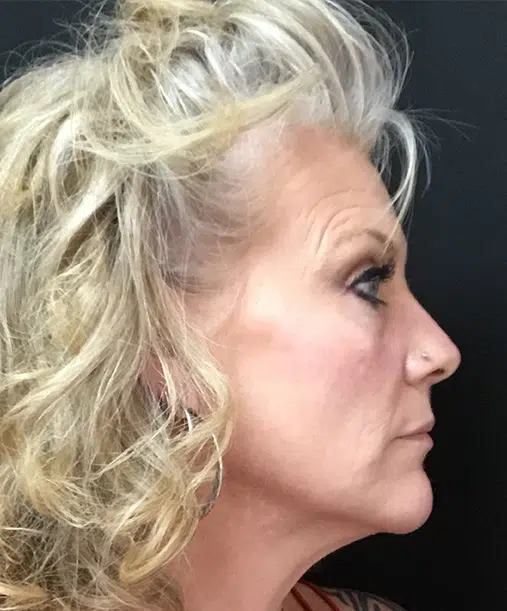 Bellafill injectable treatment for long-lasting wrinkle reduction and acne scar improvement.