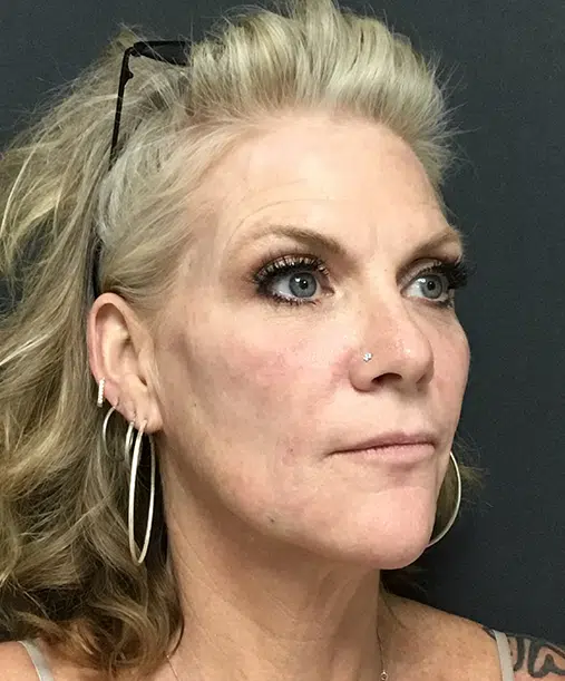 Bellafill injectable treatment for long-lasting wrinkle reduction and acne scar improvement.