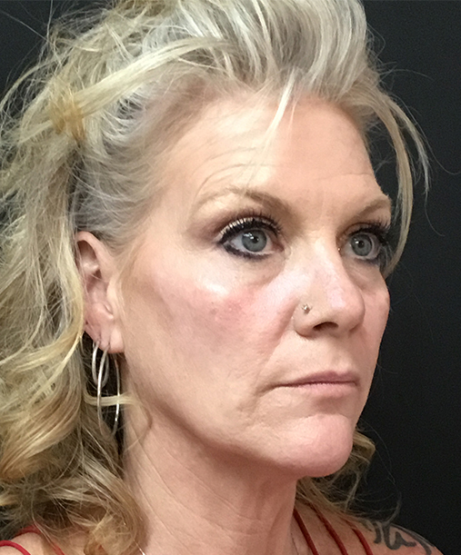 Bellafill injectable treatment for long-lasting wrinkle reduction and acne scar improvement.