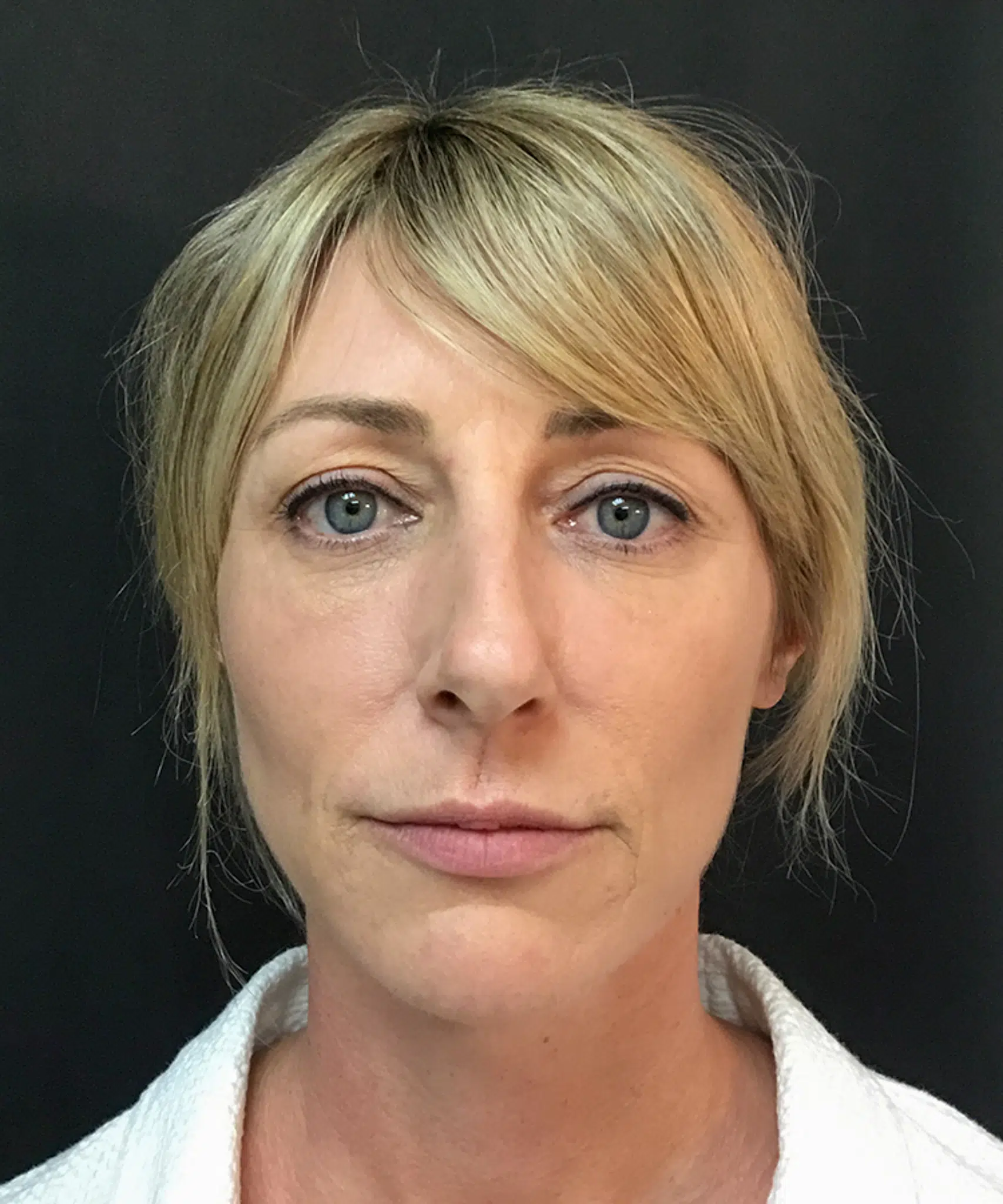 Before and after results of Bellafill treatment showing smoother skin and improved appearance of acne scars or wrinkles.