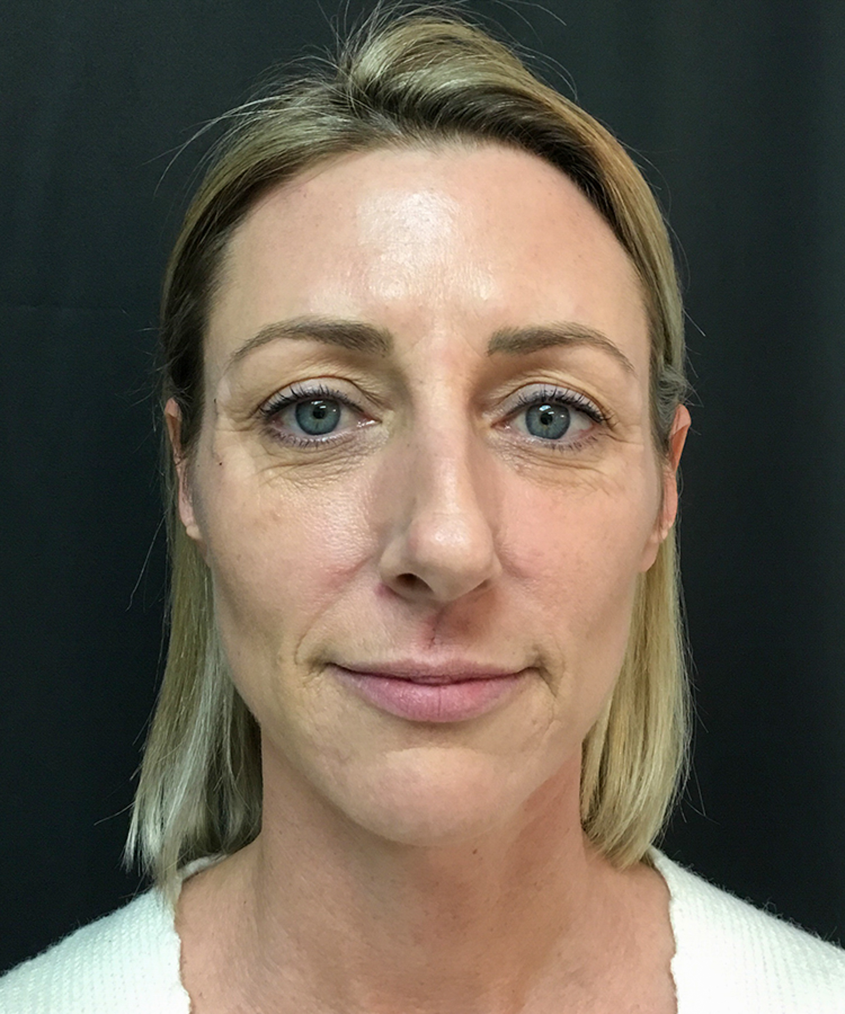 Before and after results of Bellafill treatment showing smoother skin and improved appearance of acne scars or wrinkles.