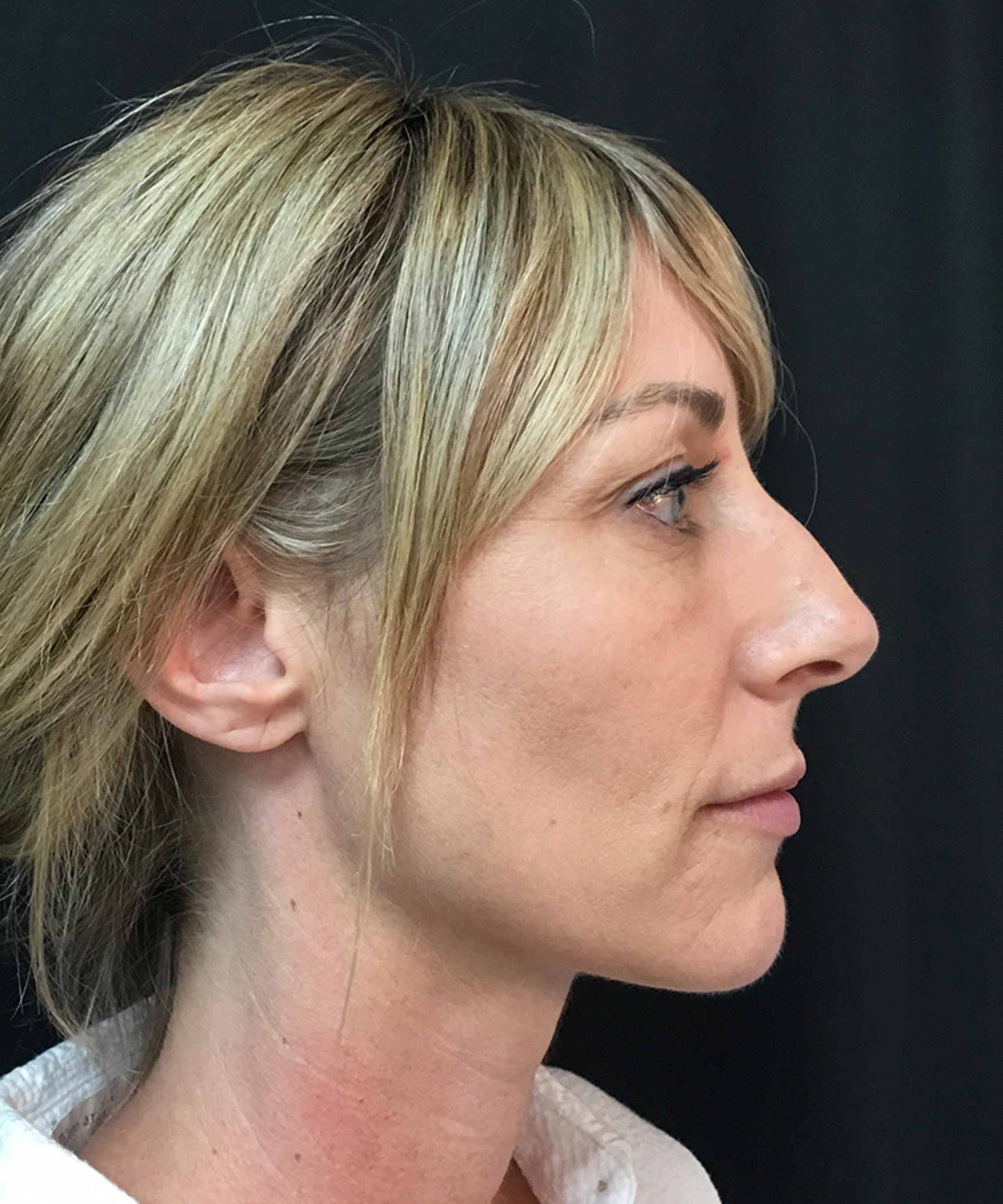 Before and after results of Bellafill treatment showing smoother skin and improved appearance of acne scars or wrinkles.