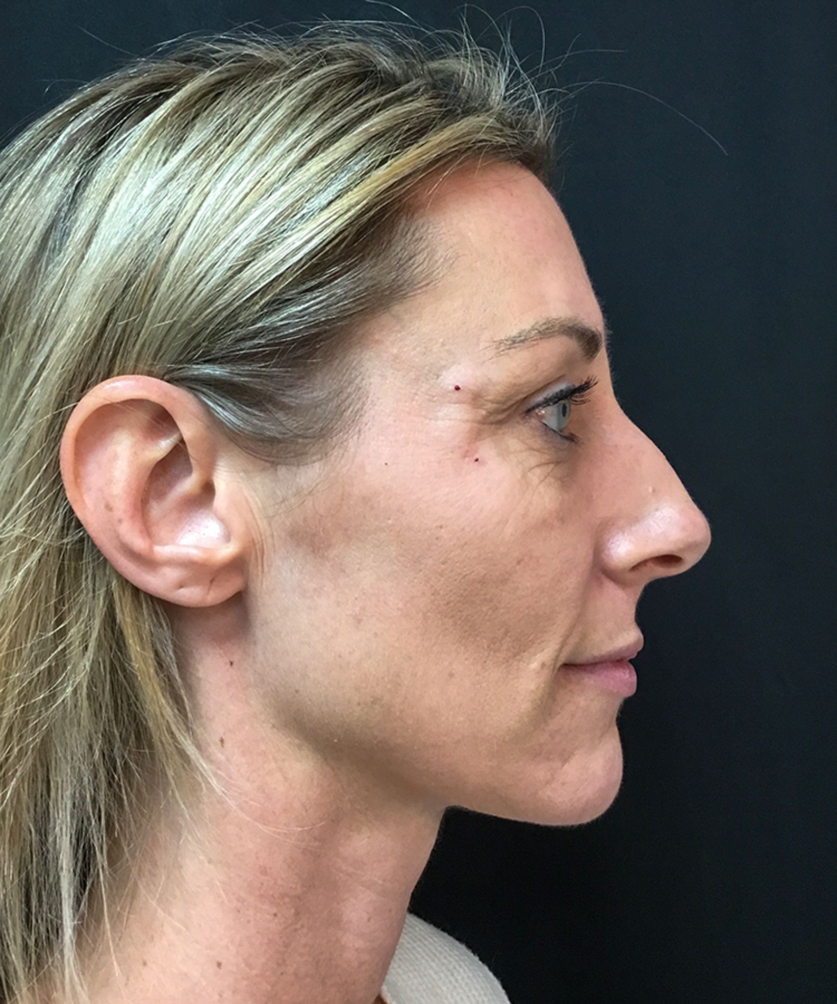 Before and after results of Bellafill treatment showing smoother skin and improved appearance of acne scars or wrinkles.