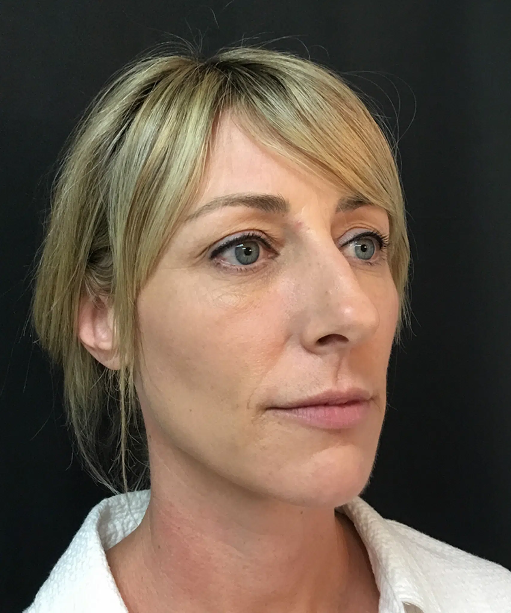 Before and after results of Bellafill treatment showing smoother skin and improved appearance of acne scars or wrinkles.