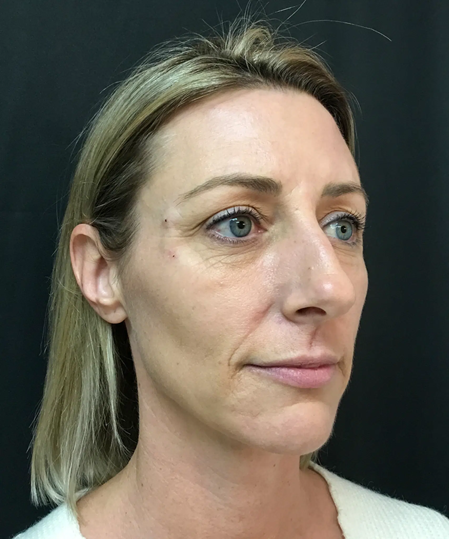 Before and after results of Bellafill treatment showing smoother skin and improved appearance of acne scars or wrinkles.