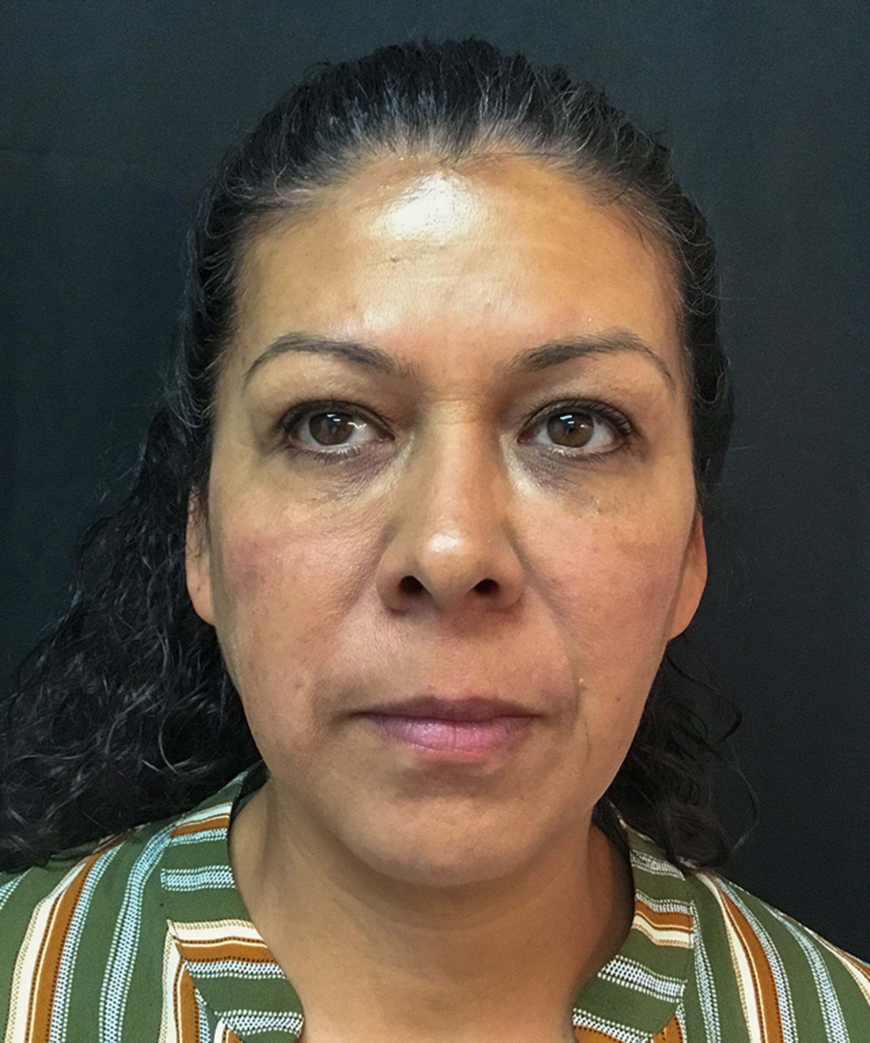 Before and after results of dermal filler treatment showing smoother, plumper skin and reduced wrinkles.
