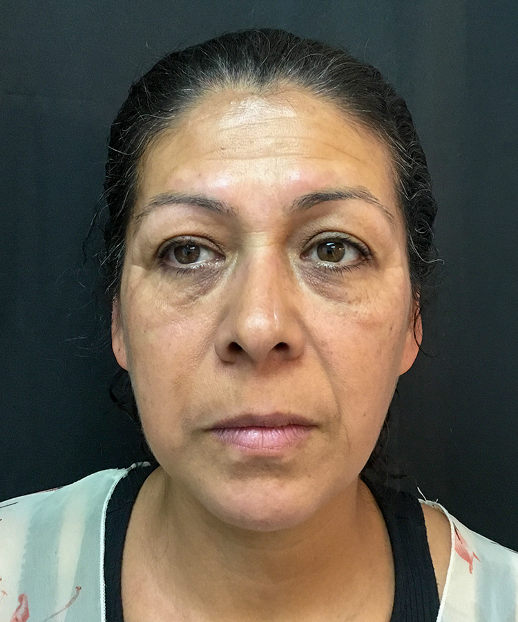 Before and after results of dermal filler treatment showing smoother, plumper skin and reduced wrinkles.