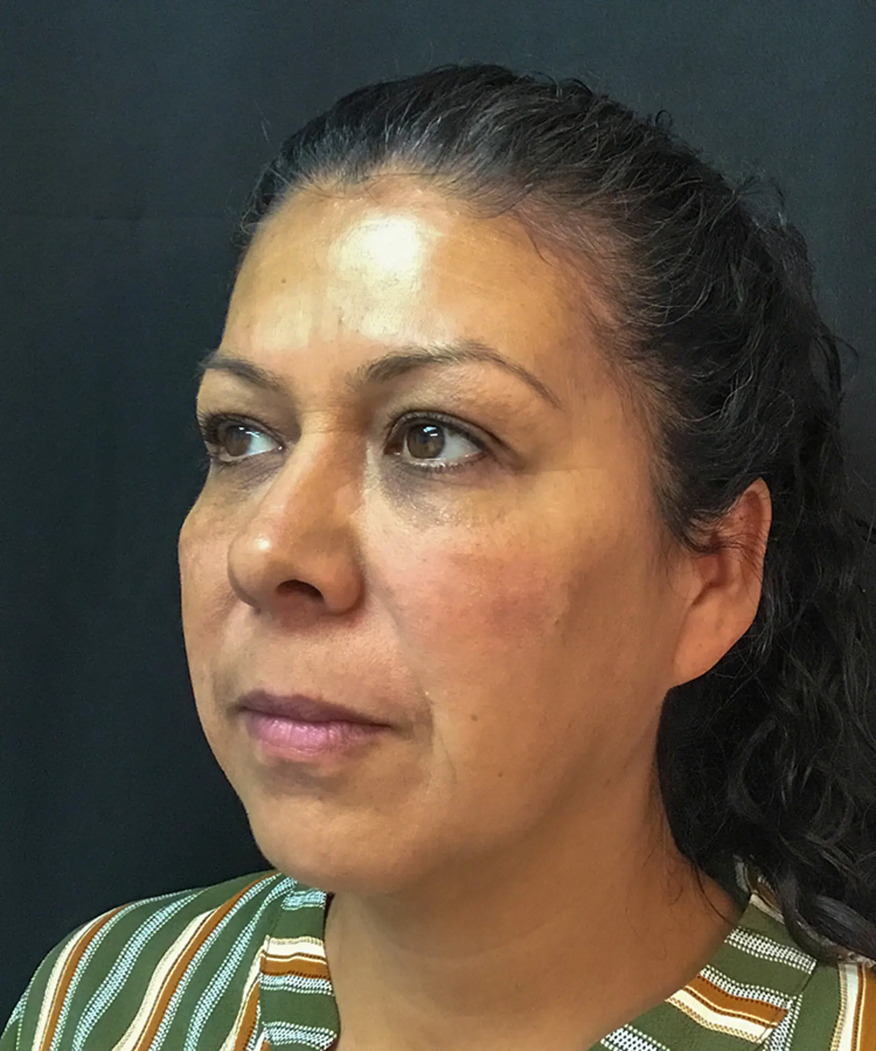 Before and after results of dermal filler treatment showing smoother, plumper skin and reduced wrinkles.