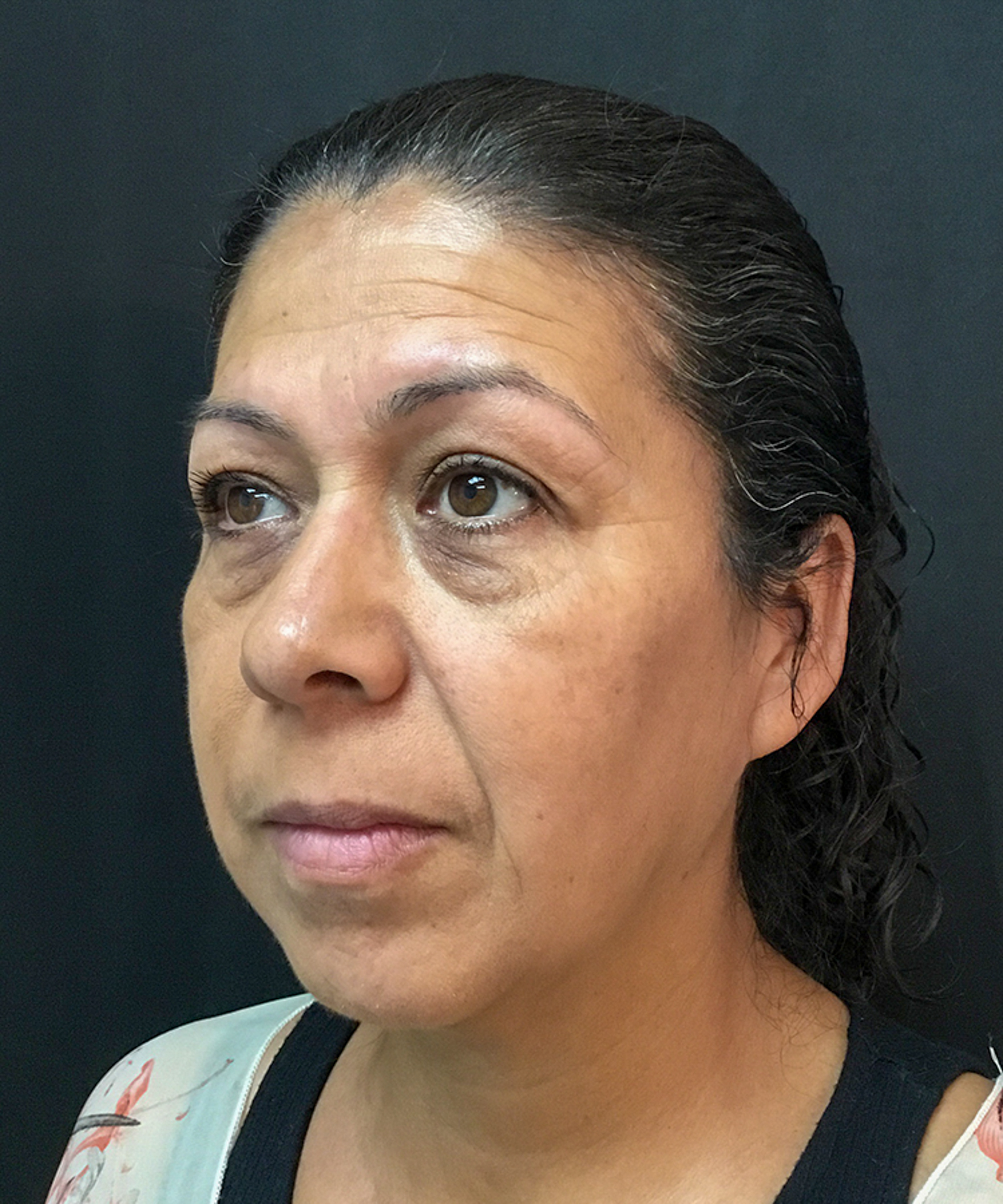 Before and after results of dermal filler treatment showing smoother, plumper skin and reduced wrinkles.