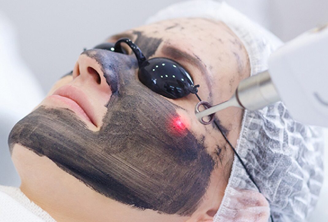 Patient receiving the Hollywood Laser Peel treatment at Bloom - Advanced Med Spa, targeting pigmentation and fine lines for smoother, glowing skin.